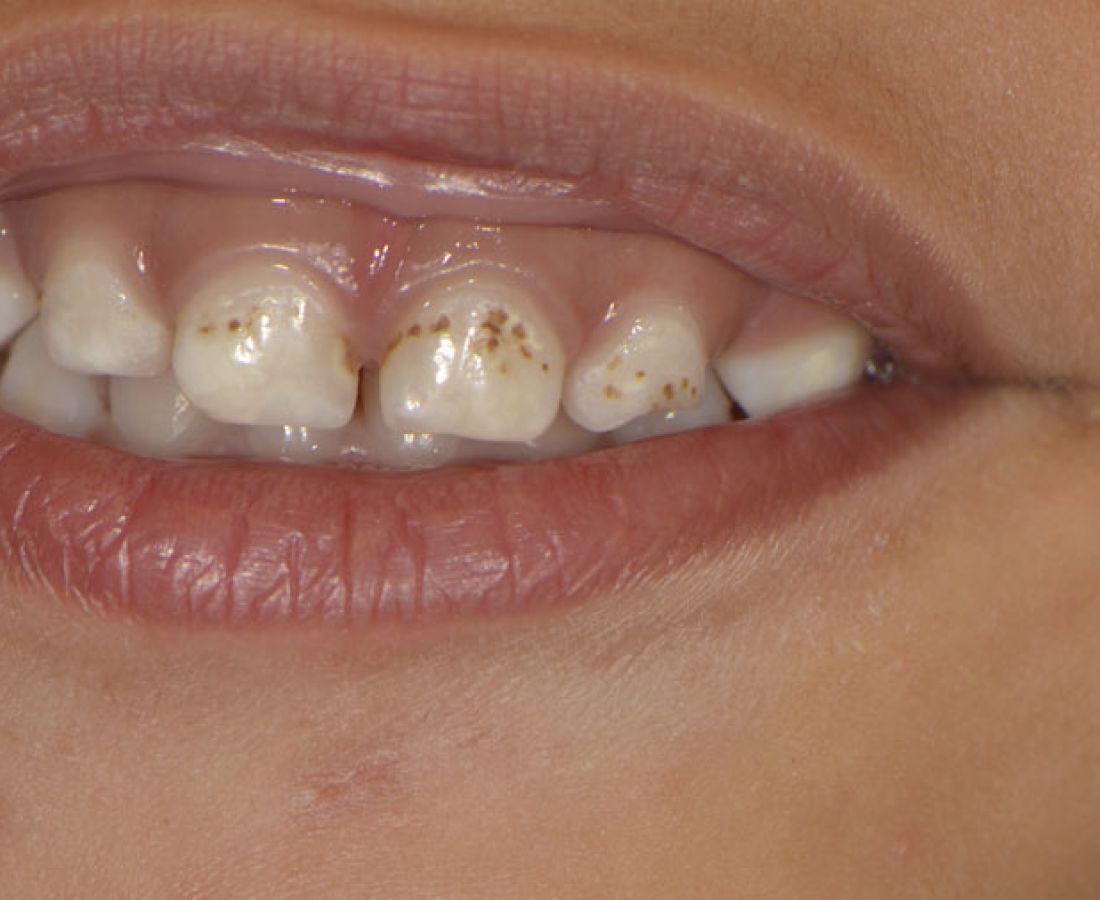 صور طبية – ألبوم صور  : تسوّس الأسنان