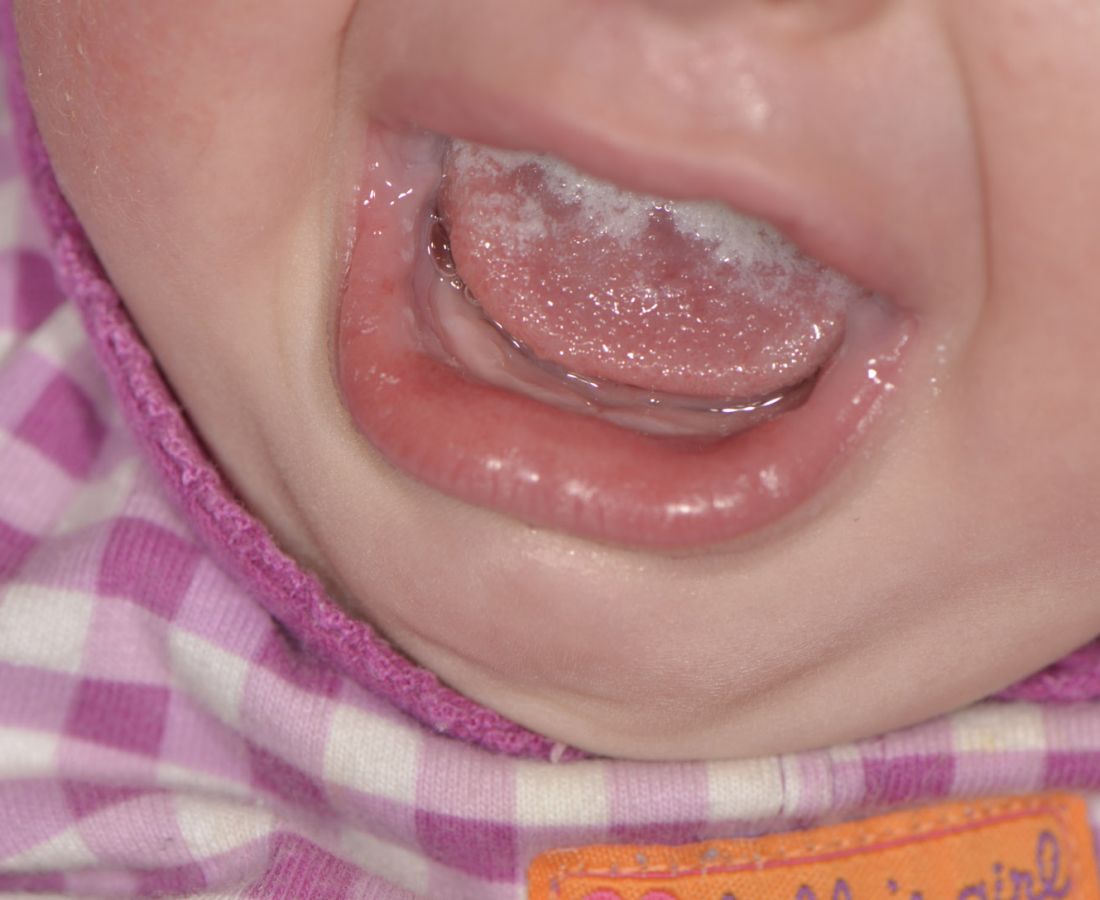 صور طبية – ألبوم صور  : التهاب الفم الفطري