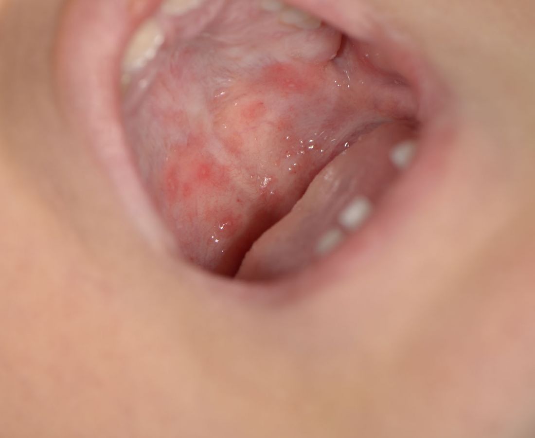 صور طبية – ألبوم صور  : القرحات الفيروسية لمخاطية الفم والبلعوم