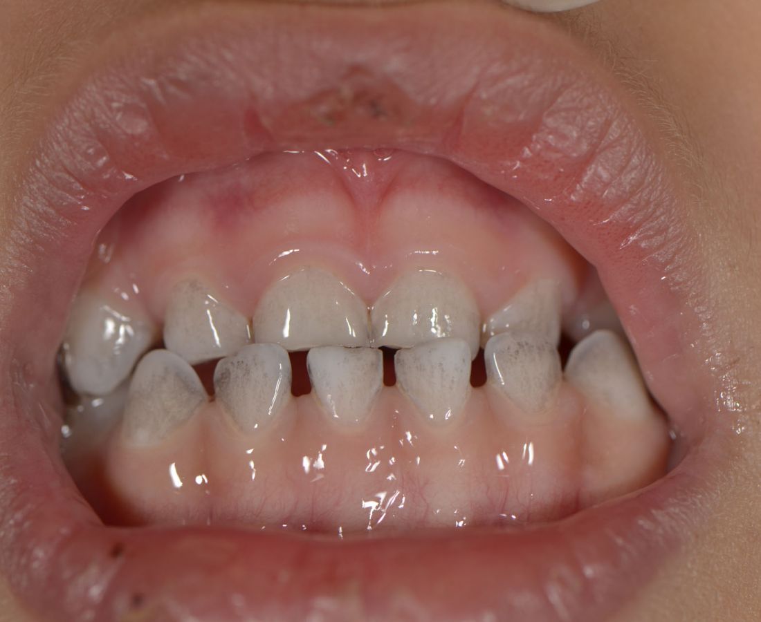 صور طبية – ألبوم صور  : اصطباغ الأسنان بدواء الحديد