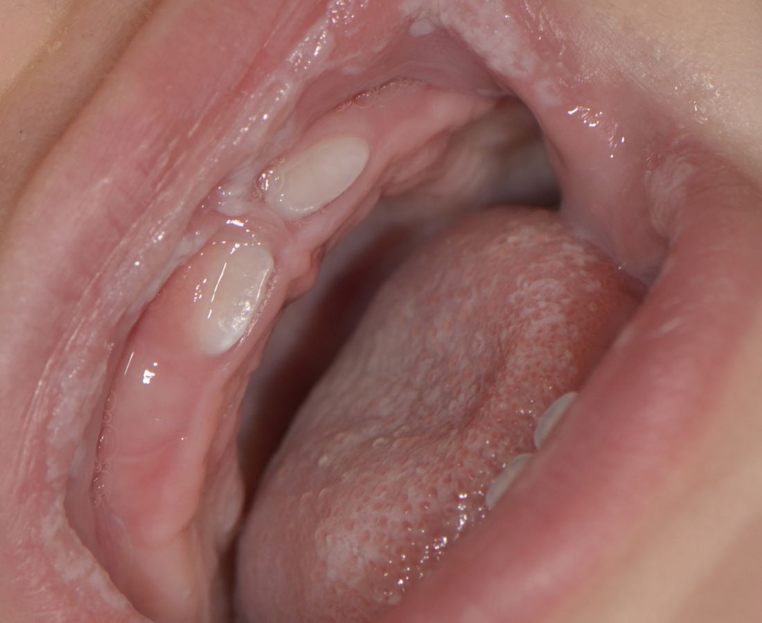 صور طبية – ألبوم صور  : التهاب الفم الفطري (2)